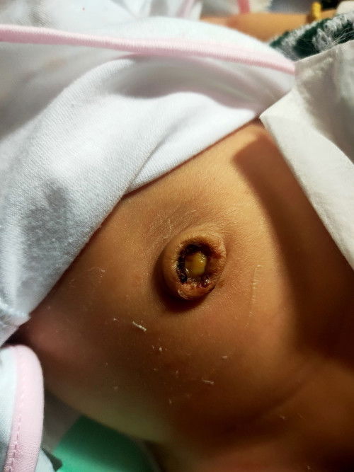 Con em vừa mới rụng rốn như hình, có bị sao hông ạ.