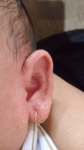 Bunda, kuping anak saya yg sebelah kanan begini, kira kira kenapa ya? Sebelah kiri nya mah ngga