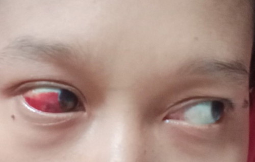 Pembuluh darah mata pecah