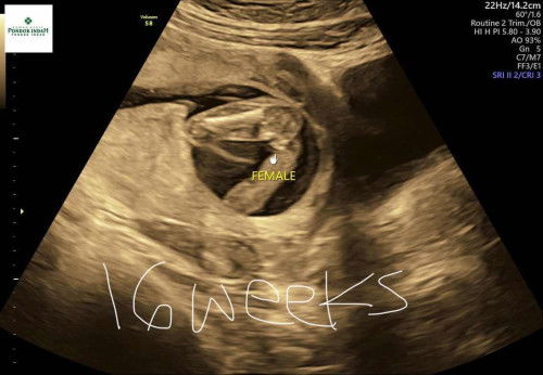 Hasil USG Jenis Kelamin 16weeks