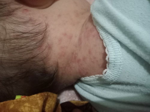 Bintik merah dan bintik kecil bernanah sekitar leher