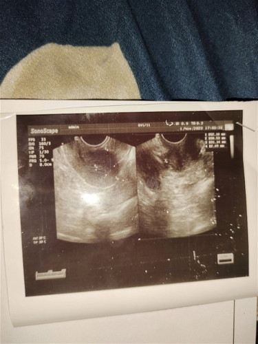 Tolong bacakan hasil usg bund🙏 ini lgi promil usg transvaginal kata dokternya gapapa sehat semua.