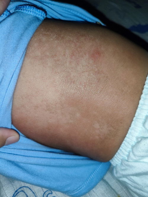 awal kemerahan lama² jdi kering, ada yg tau kah bun ini knp or ada saran lotion ?