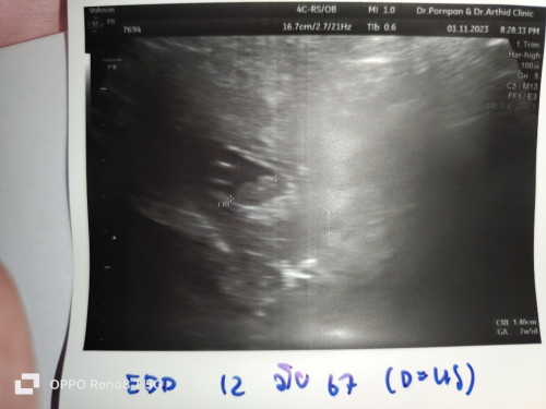 หลังจากน้องเสียในท้อง 34+5 สัปดาห์