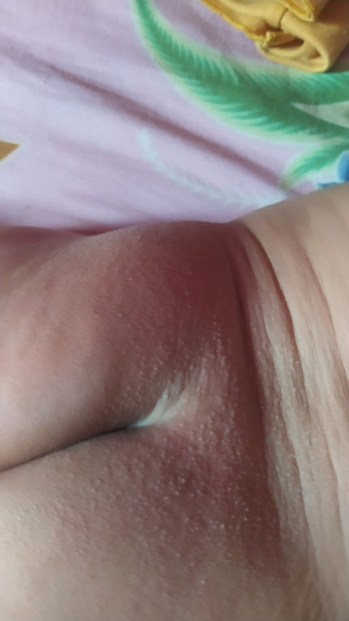 Ruam popok atau bukan