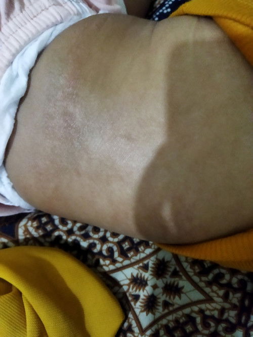 Kulit punggung bayi kasar