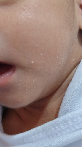 Mga butlig sa mukha at leeg ni baby