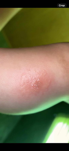 Eczema or a different skin disease?