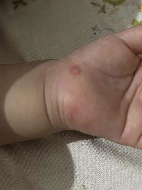 Muncul bintik merah ditangan