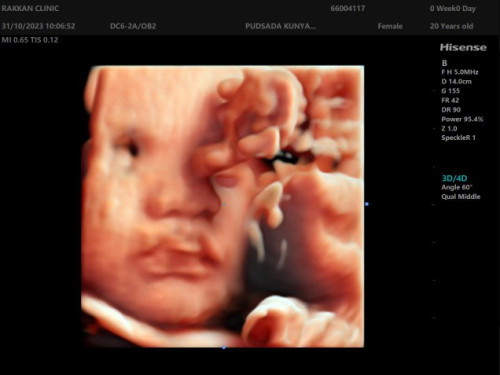 แบบนี้เรียกปากแหว่งไหมคะ ?