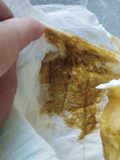 Bé đi phân nhầy