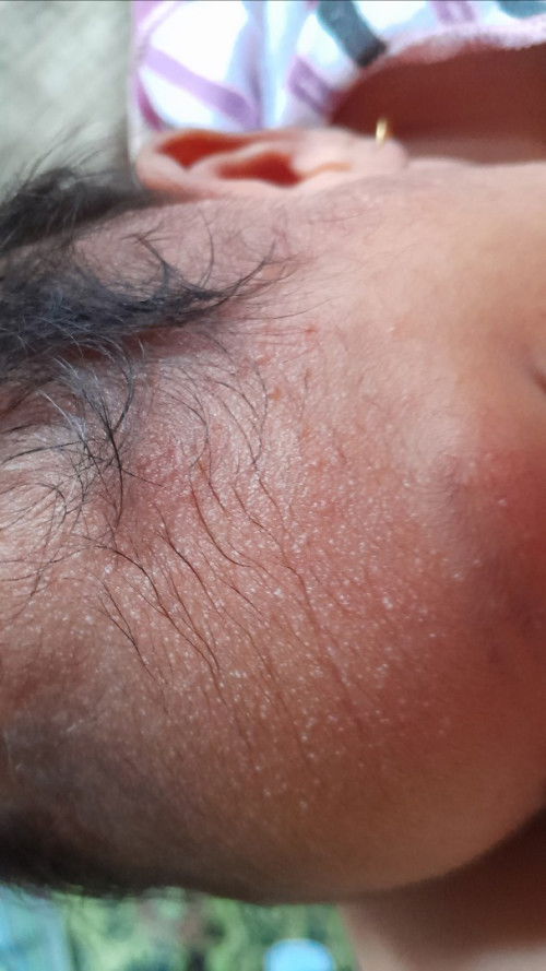 bintik putih seperti ada nanah