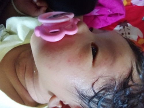 ลูกผื่นขึ้นที่หน้าแพ้อะไร