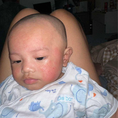 น้องเป็นผื่นแดงขึ้นเต็มหน้า