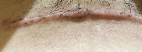 11 months of cs section