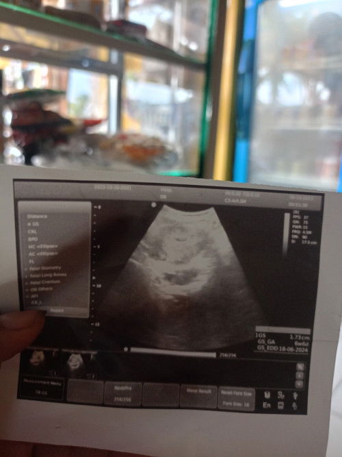 Hasil USG pas 6 Minggu menurut bunda yg bawah berupa kantung juga bukann yaa..