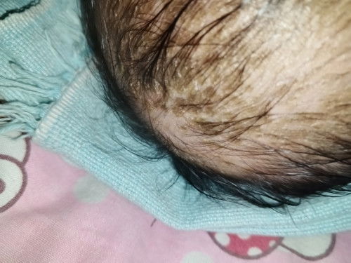 My 2 months old baby nagkaroon Po sya ng bukol sa ulo maliit Po normal Po kaya yun