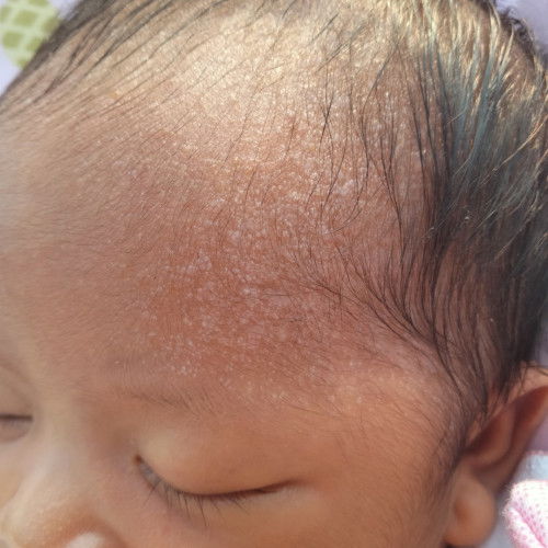 Biang keringat warna putih