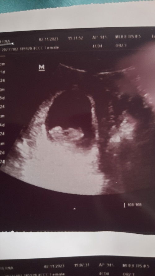 Hamil 10 week blm terdengar detak jantung