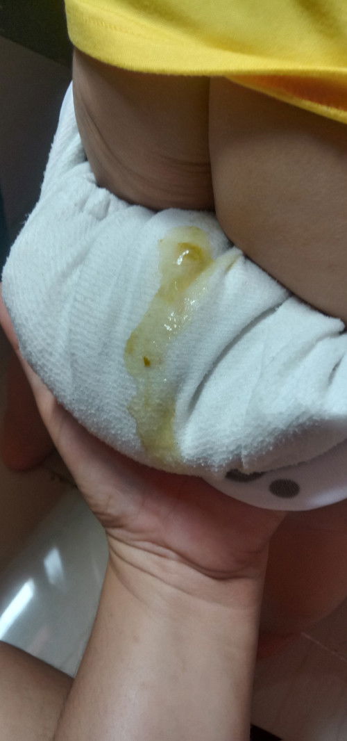 Nag poop po si Lo ng sipon normal po ba Yun?Wala po syang sipon at ubo ngayon