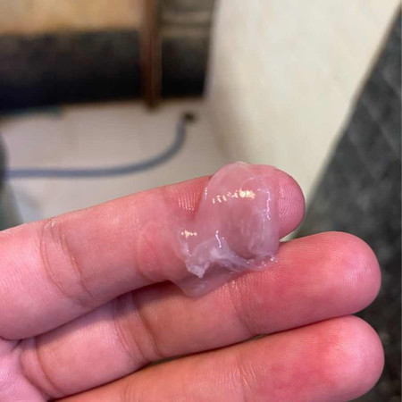 แบบนี้มูกใสหรือว่าตกขาวคะ