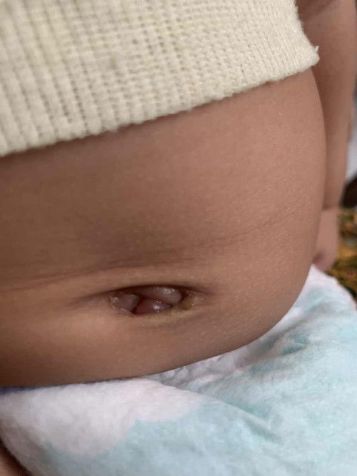 Baby udh mau 2 bulan pusar basah lagi