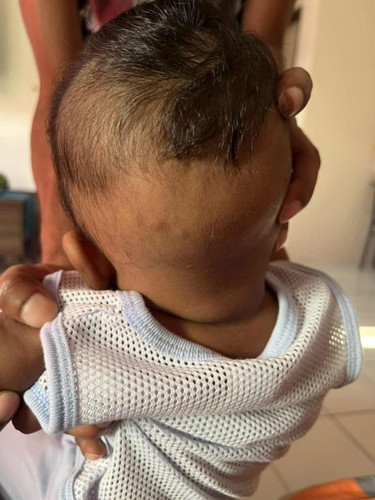 Benjolan kecik / bintik Merah kepala baby