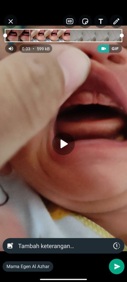 Apakah ini merupakan lip tie??