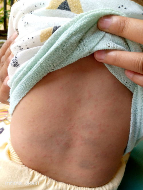 Gatal pada bayi