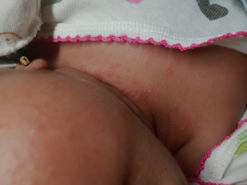 Mga mommy Natural lang po ba ang gantong rashes sa mukha at leeg ni baby, naaawa napo kasi ako.