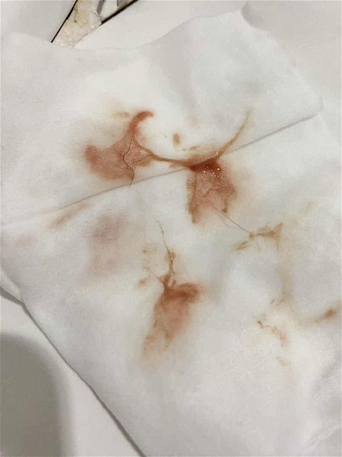 มีมูกออกสีแบบนี้อันตรายมั้ย