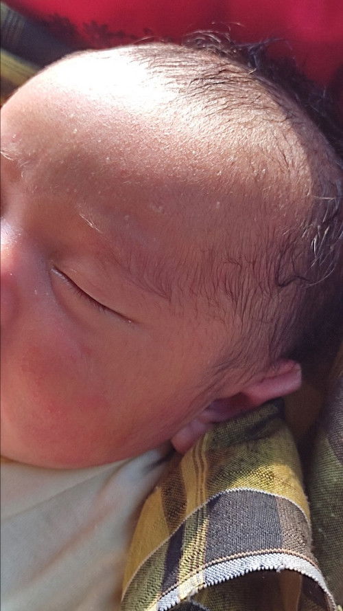 Seputaran newborn,kemerahan di pipi dan brutusan di dahi.