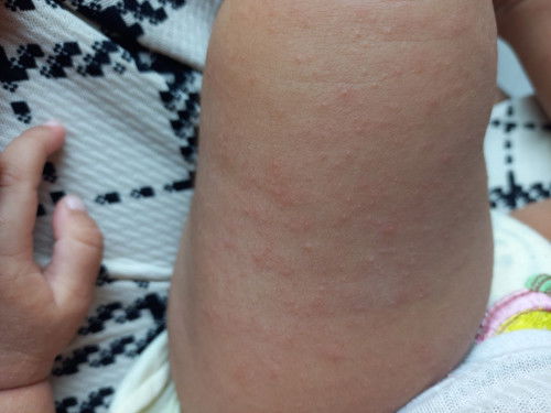 Ruam hampir di seluruh tubuh bayi 6 bulan