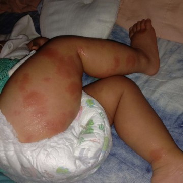 น้องไข้มา2-3วัน