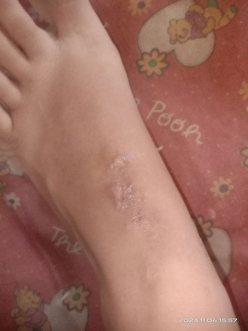 Bun mau nanya dong, hamil 29 week terus kaki ku gatal2 seperti ini, kira2 apa obatnya ya? Berair trs