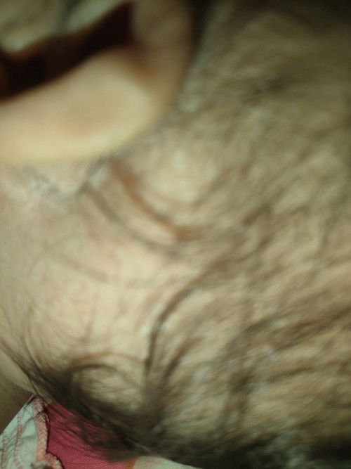 สอบถามแม่ๆค่ะพอดีน้องโดนแมลงไรกัดไม่รู้ค่ะแบบนี้จะอันตรายมั้ยค่ะผื่นขึ้นค่ะควรหาหมอมั้ยค่ะ