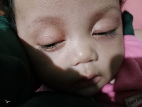 Kelopak mata seperti beruntusan dan merah