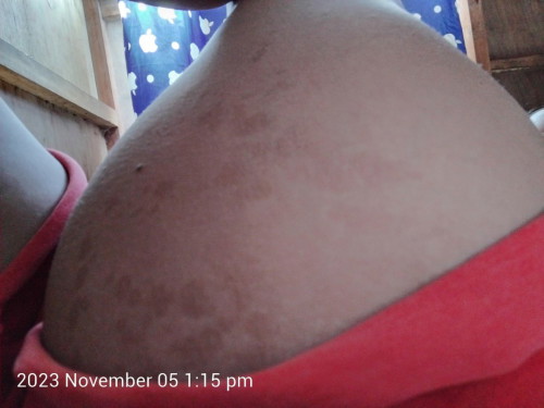 HELP PO. Ano po kaya to sa tingin nyo bigla po tumubo nung 1st tri ko.