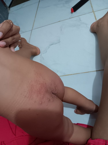 Tips biar ruam popok cepet sembuh bun .
Kemarin udah sembuh pake cream zwutsal tapi sekarang ada lg