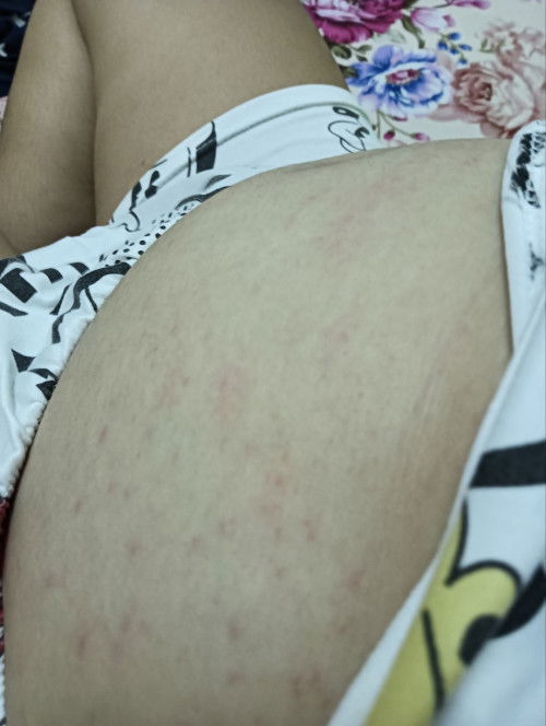 ตั้งท้องแล้วมีตุ่มแดงคันควรทำยังไงดีคะ