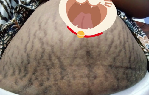 Stretch Mark
