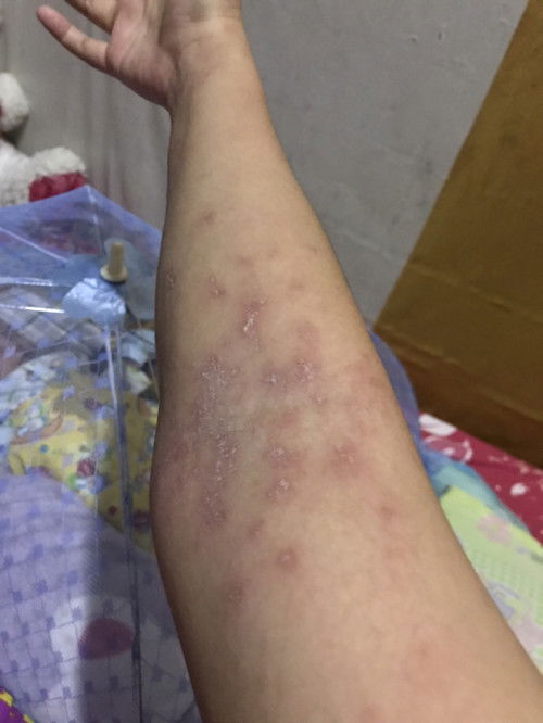 Gatal gatal setelah 2 minggu pasang implan