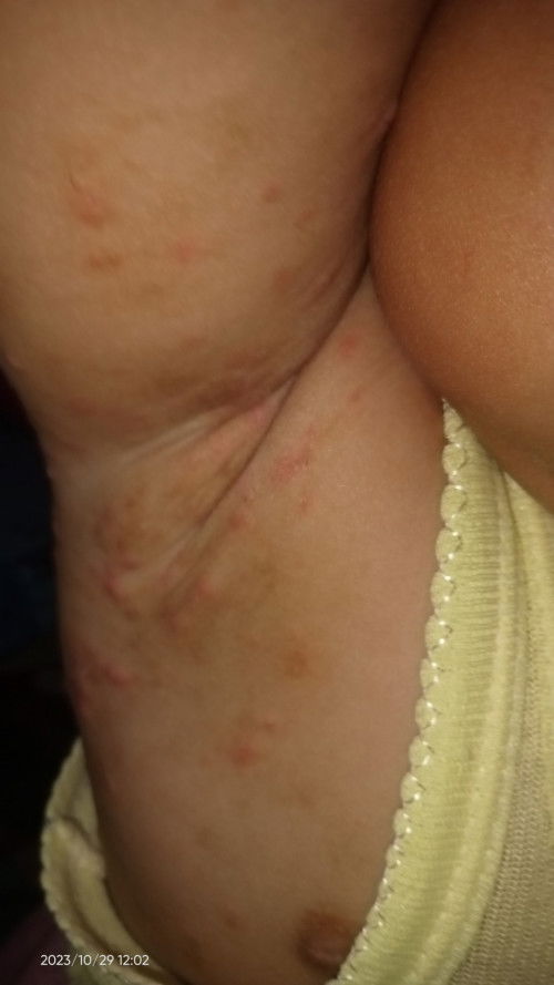 Pengobatan Scabies Yang Ampuh