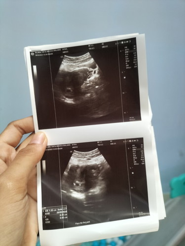 Pengen anak ke 2 cewek, mungkin ada rekomendasi makanan/buah biar anak cewek hihi skrg 6week mom π