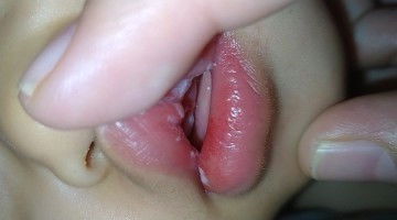 Sariawan pada bayi umur 10bln