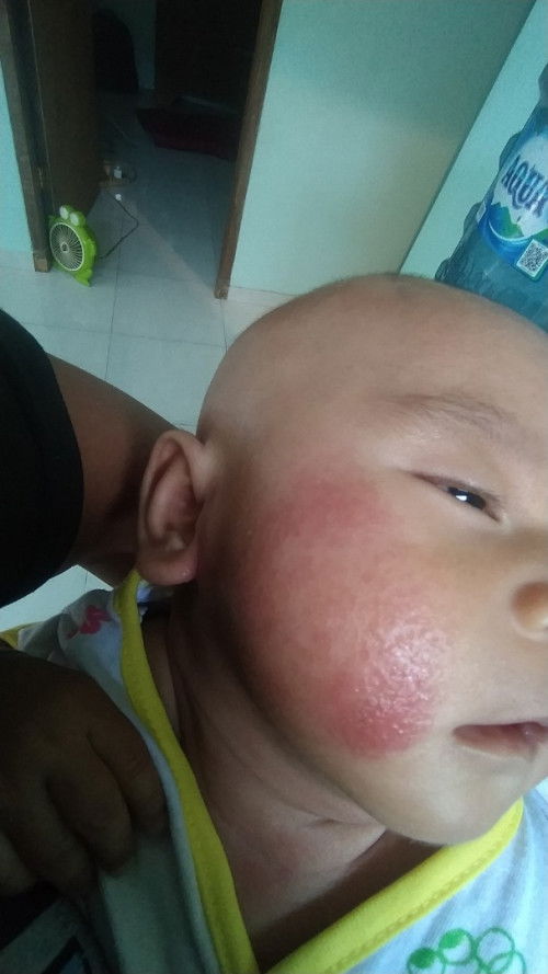 bintik merah d pipi