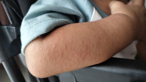 Seperti ruam di tangan