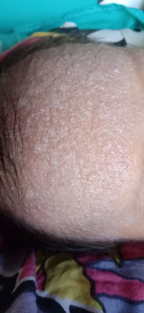 Mau tanya kalau biang keringat seperti ini bahaya tidak ya mom? 🥲