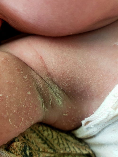 Ruam pada kulit bayi