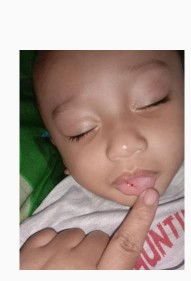 Sariawan baby 10 bulan